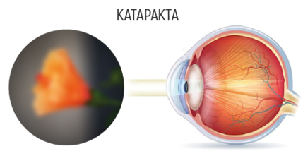 Катаракта2.png Катаракта2.png